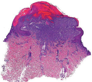 Proliferación sólida en la dermis superficial delimitada por un collarete anexial, ulcerada en superficie y con mala delimitación en profundidad (hematoxilina-eosina, ×10).