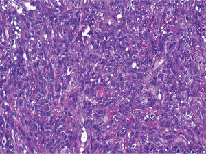 Detalle de las células epitelioides, algunas con vacuolas intracitoplasmáticas y abundantes mitosis (hematoxilina-eosina, ×200).