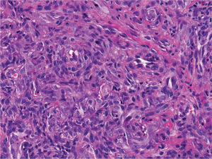 Detalle de la proliferación celular epitelioide (hematoxilina-eosina, ×200).
