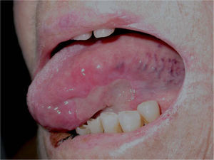 La imagen muestra una gran ulceración de márgenes irregulares recubierta por un exudado blanco-grisáceo en la superficie ventral de la lengua y áreas úlcero-costrosas en la semimucosa del labio inferior.