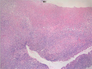 La imagen histopatológica muestra una escara fibrino-necrótica bajo la que se extiende una proliferación linfoide con afectación difusa de todo el espesor del corion mucoso (hematoxilina-eosina, ×10).