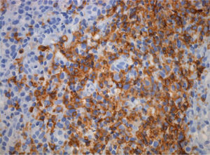 La gran mayoría de las células neoplásicas son intensamente positivas para CD20 (marcador inmunohistoquímico de linfocito B) (×40).