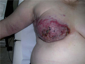 Dos semanas después, tumor con áreas necróticas y ulceradas en la mama derecha con linfedema y nódulos violáceos diseminados en la extremidad superior derecha.