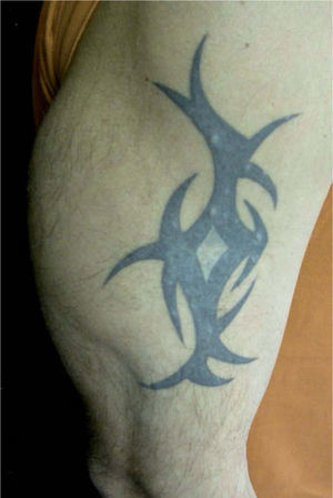 Tatuaje de tinta negra en el brazo derecho del paciente donde se observan varias pápulas blanquecinas limitadas a la zona de pigmento.