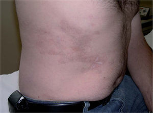Placas blanquecinas brillantes sobre fondo cicatricial con hiperpigmentación postinflamatoria en los dermatomas D9-D10.