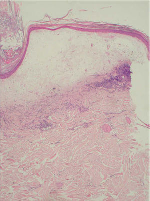 Atrofia del estrato de Malpigio con tapones foliculares, edema en dermis papilar e hialinización del colágeno con marcada infiltración inflamatoria (hematoxilina- eosina, x200).