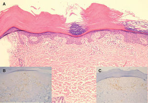 Pápula en el dorso del pie (hematoxilina-eosina, x10). A. Hiperqueratosis ortoqueratósica compacta, leve atrofia epidérmica, aplanamiento de las crestas interpapilares y escaso infiltrado inflamatorio linfocitario liquenoide en la dermis papilar. B. Inmunotinción con CD4 (PAP, x20). C. Inmunotinción con CD8 (PAP, x20).
