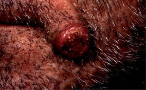 Paciente del caso 1: tumoración verrugosa, crateriforme, cercana a la comisura bucal izquierda.