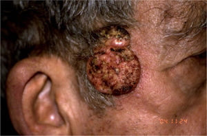 Paciente del caso 2: aspecto clínico del carcinoma verrugoso.