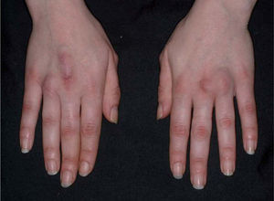 Xantomas tendinosos en los tendones extensores de los dedos de las manos (paciente 2).