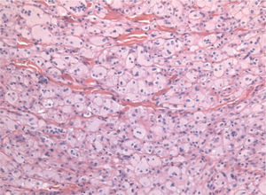 Imagen histológica de un xantoma tendinoso (hematoxilina-eosina, ×100) (paciente 2). Células xantomizadas separadas por bandas de colágeno.