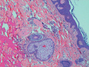 Fibroma perifolicular (hematoxilina-eosina, x400).