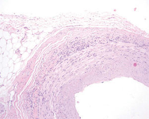 Arteria temporal de pared engrosada con un moderado infiltrado inflamatorio en las capas media y adventicia. Hematoxilina-eosina, x4.