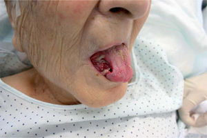Úlcera muy dolorosa, no infiltrada a la palpación, en el lado derecho de la lengua.