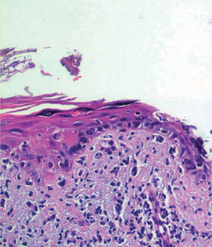 Atipia citológica epidérmica e infiltrado inflamatorio en la dermis (hematoxilina-eosina, x400).