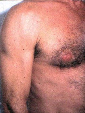 A menudo, en el contexto del síndrome lipodistrófico, se produce un aumento de la grasa visceral abdominal e hipertrofia mamaria.