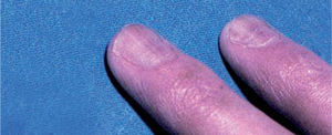 La hiperpigmentación de las uñas asociada a la zidovudina puede presentarse como bandas longitudinales.