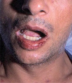 Afectación de la mucosa oral en un caso de síndrome de Stevens-Johnson inducido por nevirapina.