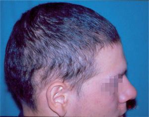 Resultado a los 6 meses del empleo de metilprednisolona 500mg intravenosos al día durante 3 días consecutivos al mes. Se aprecia una repoblación de casi el 90 % del cuero cabelludo.