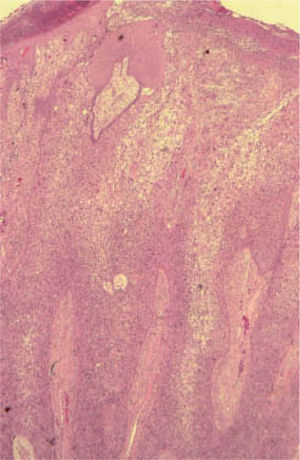 Patrón de células claras tipo diferención anexial derivado de la enfermedad de Bowen. Hematoxilina/ eosina (H/E) ×40.