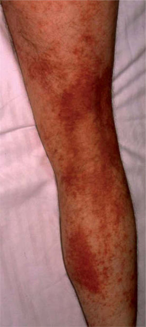 Lesiones eccematosas en la parte posterior de la pierna, con componente purpúrico en algunas zonas.