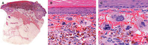 A. Proliferación celular en placa, asimétrica y bien delimitada, no ulcerada, situada en la dermis. Pigmento pardusco distribuido de forma uniforme en toda la lesión. B. Proliferación de células con marcado pleomorfismo, núcleos atípicos hipercromáticos, citoplasma espumoso abundante y contornos celulares mal definidos. Extensa hemorragia intratumoral. C. Células gigantes tumorales multinucleadas atípicas, figuras de mitosis anormales y signos de eritrofagocitosis (presencia de hematíes, glóbulos eosinofílicos y depósitos de hemosiderina en el citoplasma de las células neoplásicas). (Hematoxilina-eosina, A × 16, B × 200, C × 400.)