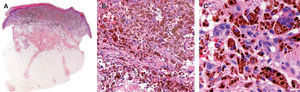 A. Otra sección correspondiente a la misma lesión muestra una proliferación celular difusa, pigmentada uniformemente, de silueta asimétrica, ocupando la dermis, recubierta por una epidermis intacta. B. Abundantes depósitos de un pigmento ocre, correspondiente a hemosiderina, en el interior del citoplasma de la mayoría de las células tumorales, que muestran una disposición en masas sólidas. C. El citoplasma de las células neoplásicas se halla repleto de intensos depósitos de hemosiderina. (Hematoxilina-eosina, A × 100, B × 200, C × 400.)