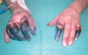 Grangrena seca con momificación de varios dedos de ambas manos.