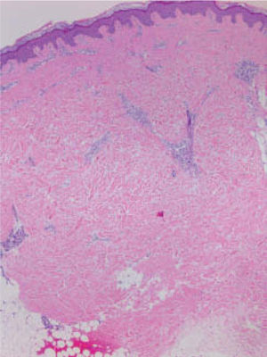 Engrasamiento y esclerosis de los haces de colágeno dérmico, con infiltrado inflamatorio perivascular moderado formado por linfocitos y algunas células plasmáticas. Hematoxilina-eosina, x10.