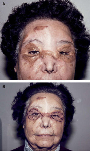 A. Placas xantomatosas periorbitarias en la paciente del caso 2. B. Tres meses después de la intervención quirúrgica.