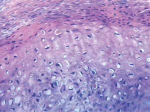 Ocasionales queratinocitos necróticos, sin imágenes de degeneración vacuolar de la capa basal. Hematoxilina-eosina, ×400.