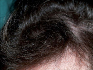 Mechón de cabello alterado, con tallos de diferente longitud, aspecto seco y presencia de múltiples nódulos blanquecino-grisáceos.