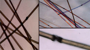 Imagen de microscopia óptica y de luz polarizada de los cabellos. Pueden observarse las características imágenes de pincel en las fracturas completas y de dos pinceles enfrentados en los nódulos.