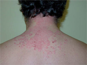 Paciente afecto de sebopsoriasis de localización en la zona de implantación del cabello en la región occipital.
