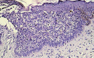 Nidos de células basaloides que partiendo desde la epidermis se disponen en empalizada sin infiltrar la dermis (hematoxilina-eosina ×40).