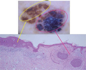 Infiltrado linfocitario en banda en la dermis papilar con escasos melanófagos.