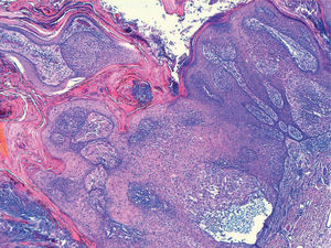 En la mitad derecha de la imagen se observa una queratosis seborreica con acantosis, puentes intraepidérmicos y transición a enfermedad de Bowen, con desorganización de queratinocitos y zonas de disqueratosis (hematoxilina-eosina, ×10).