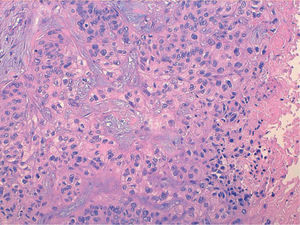 Infiltración dérmica por carcinoma epidermoide con células epiteliales atípicas, hipercromáticas y con mitosis (hematoxilina-eosina, ×20).