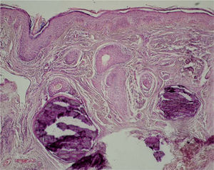 Depósitos cálcicos dérmicos asociados a signos de daño actínico (hematoxilina-eosina, ×200).