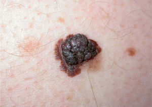 Lesión pigmentaria atípica, asimétrica de bordes, policroma y con proliferaciones en su superficie.