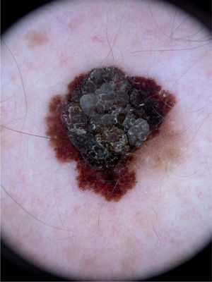 Imagen dermatoscópica en la que se evidencia un retículo pigmentario muy atípico, policromía, proyecciones irregulares y velo azul.