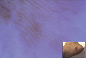 Lesión pigmentada plana, heterocroma, de 2cm de diámetro, en el talón derecho. Dermatoscopia: patrón dermoscópico de la cresta.