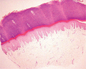 Hiperplasia epidérmica con melanocitos distribuidos de forma salpicada a lo largo de la unión dermoepidérmica. (Hematoxilina-eosina, ×10)