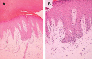 Detalle de la proliferación de melanocitos atípicos en torno a los ductos ecrinos. (Hematoxilina-eosina, ×40)