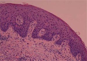 Imagen histopatológica de la lesión de la espalda (hematoxilina-eosina ×40).