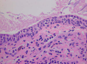 Áreas revestidas por epitelio columnar pseudoestratificado de tipo urotelial (hematoxilina-eosina, ×200).