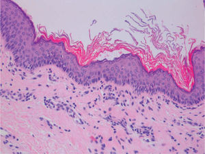 Áreas revestidas por epitelio plano estratificado queratinizado de tipo escamoso (hematoxilina-eosina, ×200).