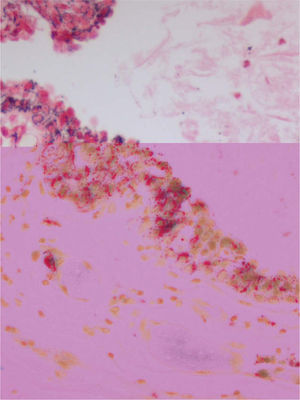 Pigmento melánico en el citoplasma de las células epiteliales y en melanófagos subepiteliales (Masson-Fontana, ×200).