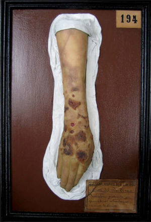 Figura de cera del Museo Olavide titulada«Dermatosis producida por quemaduras voluntarias en una histérica», que corresponde al modelado de la segunda paciente presentada en el artículo de Azúa.