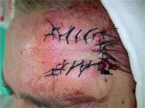 La tensión de la sutura puede ser la causa de posibles complicaciones futuras.